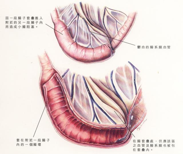 肠套叠模式图