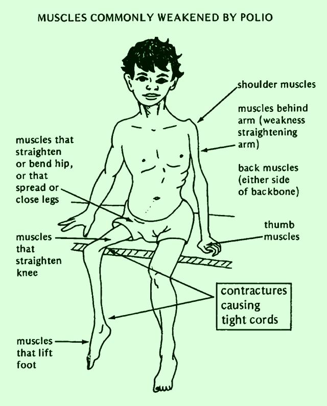 脊髓灰质炎所致的肌肉衰弱