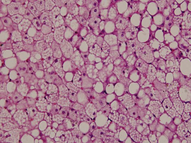 肝细胞脂肪变图片