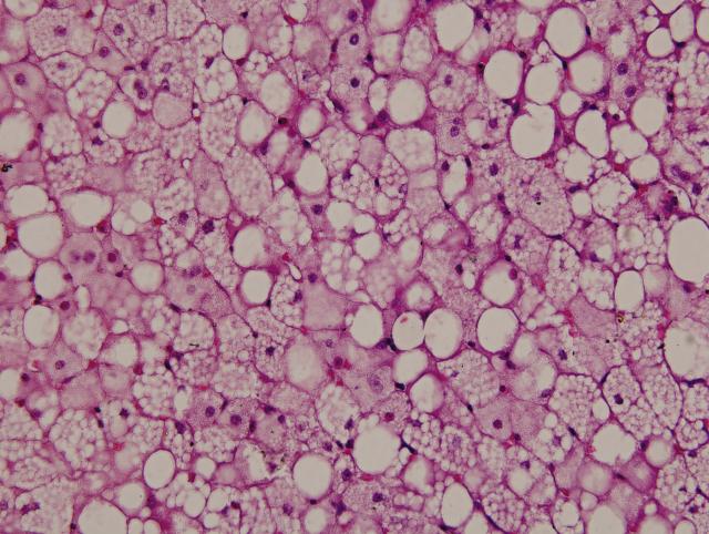 肝脂肪变性镜下图图片