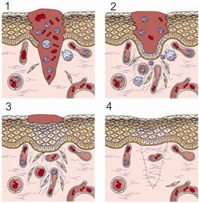 痂皮下愈合过程示意图