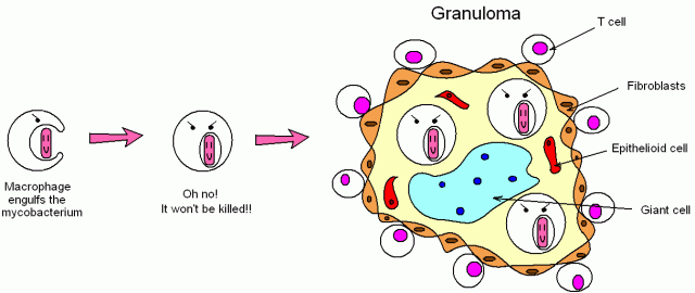 结核性肉芽肿的形成示意图