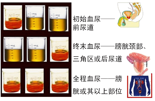 尿三杯试验