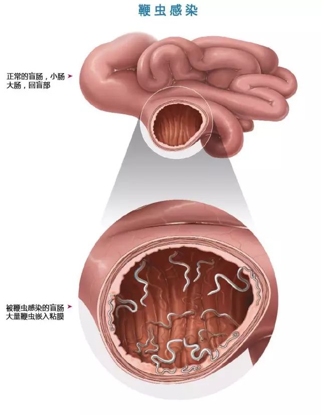 毛尾线虫病鞭虫病